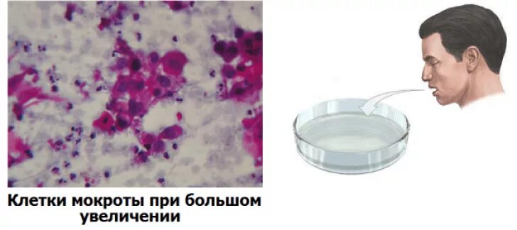 Большое отделение мокроты. Цитоморфологическое исследование мокроты. Туберкулез клетки цитология. Исследование атипических клеток мокроты. Микроскопия мокроты при ХОБЛ.