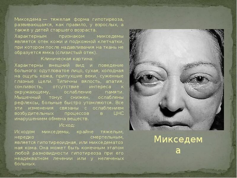 Мексидема. Муцинозный отек (микседема). Что такое микседематозные (слизистые отеки)?. Микседема (слизистый отёк) развивается вследствие:. Микседема и тиреотоксикоз.