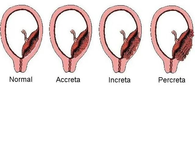 Плацента на рубце матки. Врастание плаценты классификация. Предлежание плаценты гистология. Плотное прикрепление и врастание плаценты.