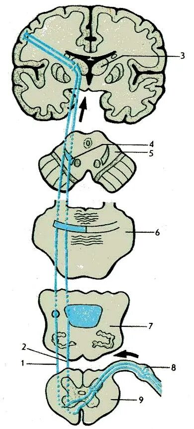 Латеральный спиноталамический тракт. Схема спинно-таламического пути. Передний спинно-таламический путь. Латеральный спинно-таламический путь.