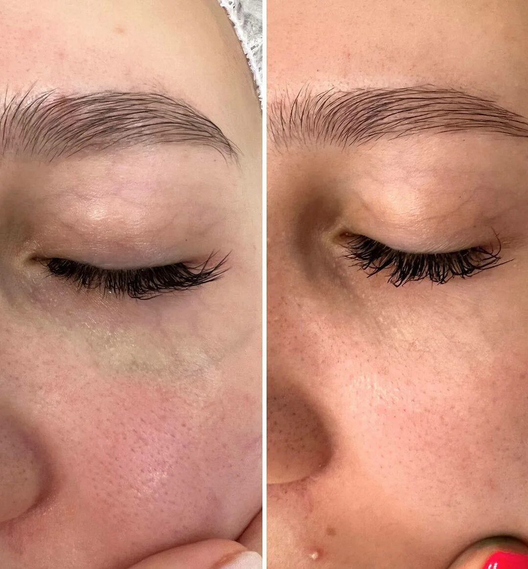 Мезопрепарат от темных кругов под глазами. Розацеа фотокоагуляция. Лазерное удаление синяков. Эффект тиндаля носослезная борозда. Мезотерапия синяки под глазами.