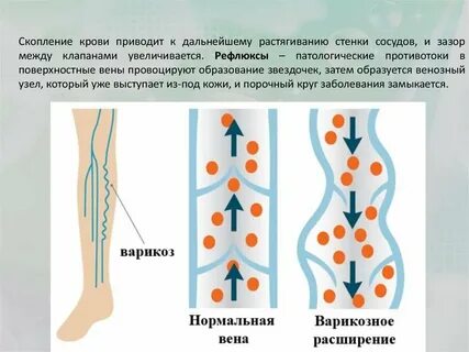 Тромбоз вен карта смп