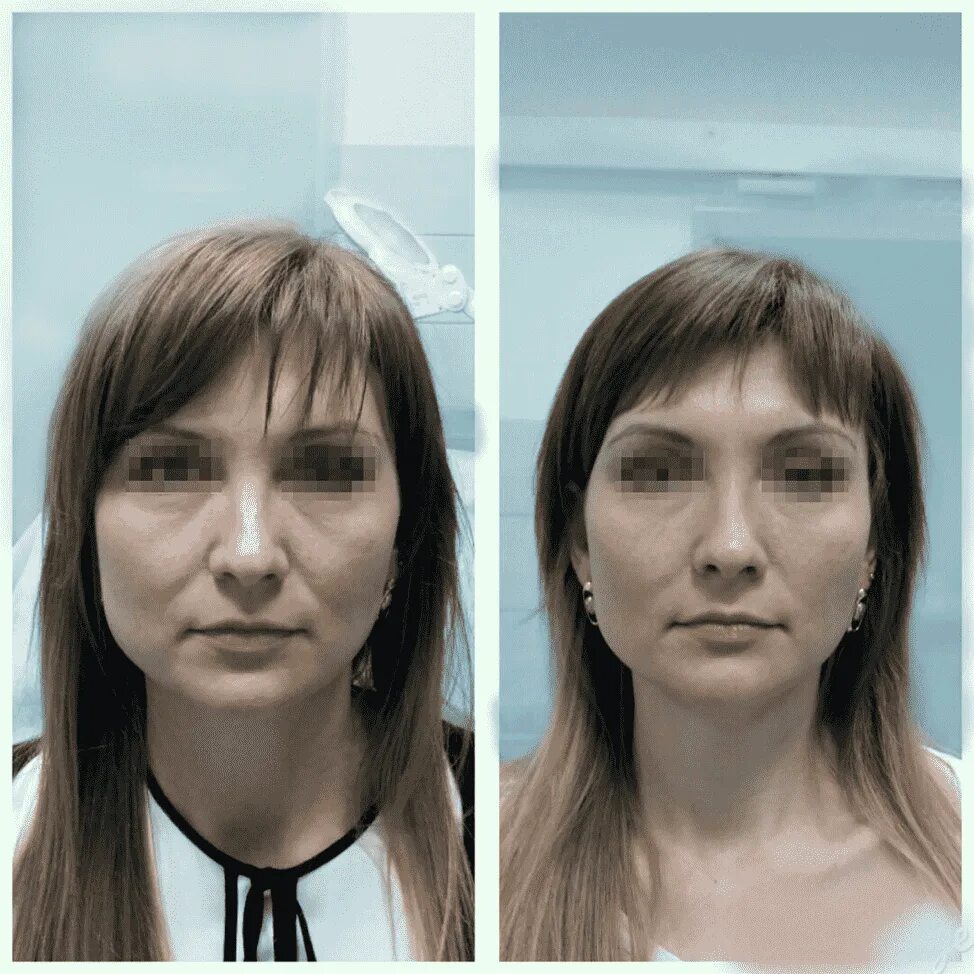 Для лиц со средним. Исправление асимметрии лица. контурная пластика лица. коррекция овала лица до и после. филлеры асимметрия лица.