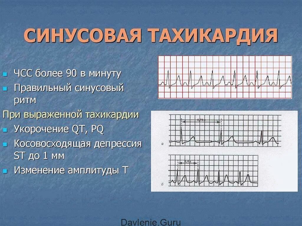 Синусовая тахиаритмия на экг. Синусовая тахикардия определение схема экг. Физическая нагрузка и ее влияние на частоту сердечных сокращений чсс. Экг патология синусовая тахикардия. Пароксизмальная суправентрикулярная тахикардия экг.