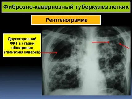 Кавернозный туберкулез история болезни