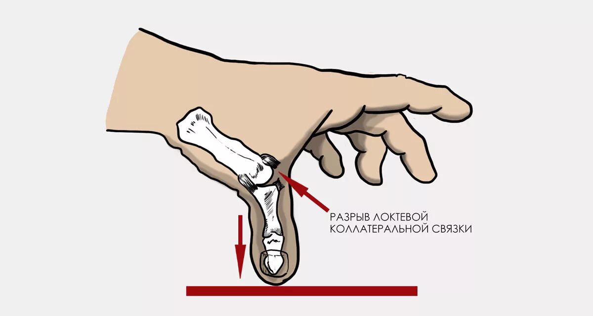 разрыв связок пястно-фалангового сустава. разрыв связки большого пальца. разрыв связки большого пальца руки. коллатеральные связки большого пальца руки. разрыв связки большого пальца руки.