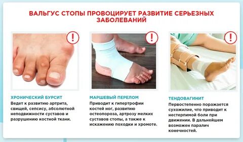Отзывы операции вальгусная деформация