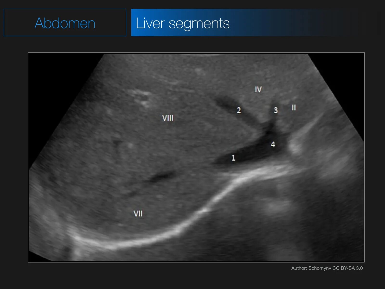 Сегменты печени на УЗИ Изранов. Ультразвуковая анатомия печени сегменты. 4 Сегмент печени на УЗИ. 1 Сегмент печени на УЗИ. Узи печени схема