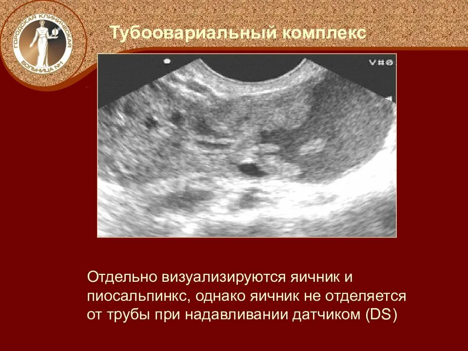 Что значит маточные трубы не визуализируются