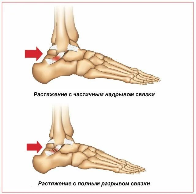 Растянутые связки