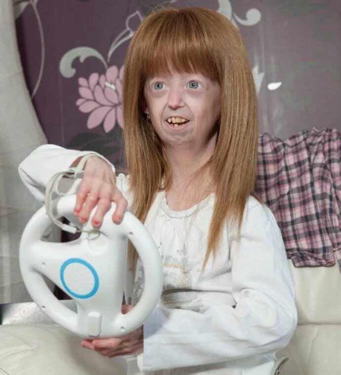 прогерия хатчинсона-гилфорда. прогерия взрослых синдром вернера. прогерия синдром вернера. прогерия (синдром хатчинсона–гилфорда). старение детей.