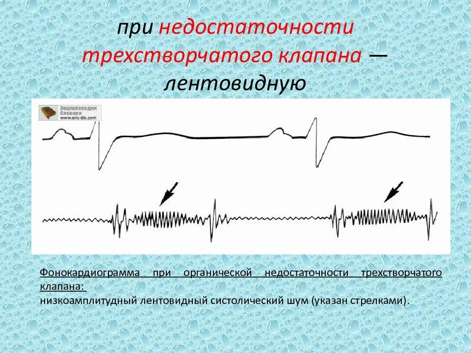 Митральная недостаточность фонокардиография. Недостаточность трикуспидального клапана ФКГ. Митральный стеноз ФКГ. Стеноз митрального клапана фонокардиограмма. Низкоамплитудная экг что это значит