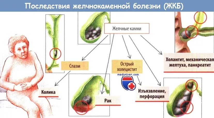 Желчекаменная болезнь осложнения. Осложнения желчнокаменной болезни. Осложнения при желчекаменной болезни. Холелитиаз осложнения. Осложнения желчнокаменной