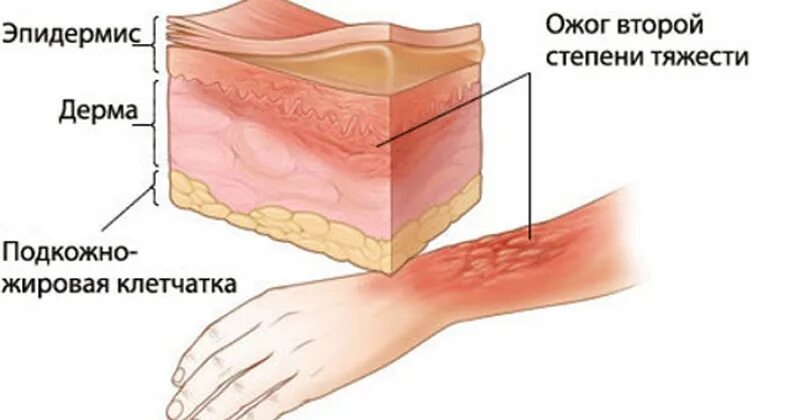 Ожог 2 степени степень тяжести