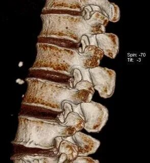 Кт позвоночника отделы