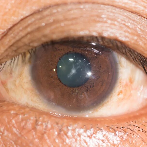 Пресенильная катаракта. Сублюксированная катаракта. Гипокальциемическая катаракта. Старческая дуга (Arcus senilis). Начальная старческая катаракта