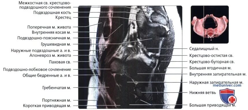 Доступы к крестцово подвздошному сочленению. Крестцово-подвздошное сочленение. Крестцово подвздошном сочленения МРРТ. Протокол мрт крестцово-подвздошного сочленения. Мрт крестцово-подвздошных сочленений заключение.