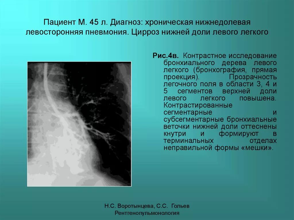 Пневмония в правой нижней доле. Внебольничная нижнедолевая пневмония рентген. Левосторонняя нижнедолевая пневмония рентгенограмма. Левосторонняя нижнедолевая очаговая пневмония. Нижнедолевая очаговая пневмония рентген.