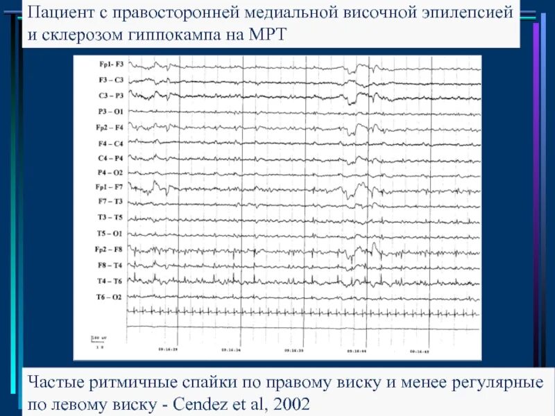 Приступы височной эпилепсии. Височная эпилепсия на ээг. симптоматическая височная эпилепсия. симптоматическая мезиальная височная эпилепсия. ээг при височной эпилепсии.