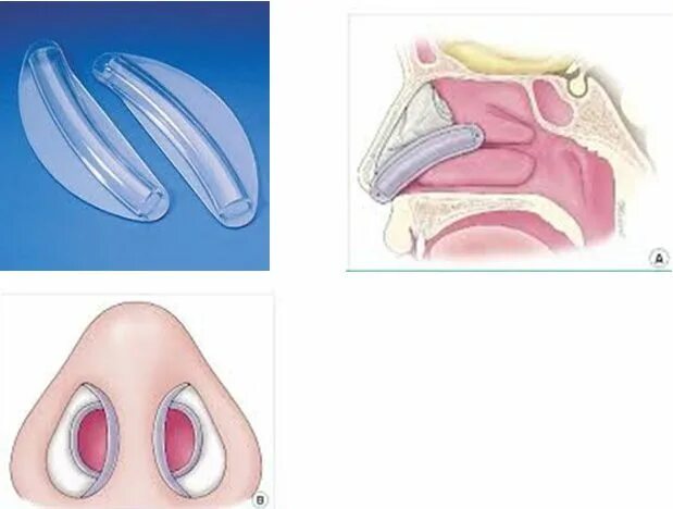 Вазомоторный ринит септопластика. Носовые сплинты силиконовые. Гипертрофия слизистой носовой перегородки. Тампоны в нос после операции
