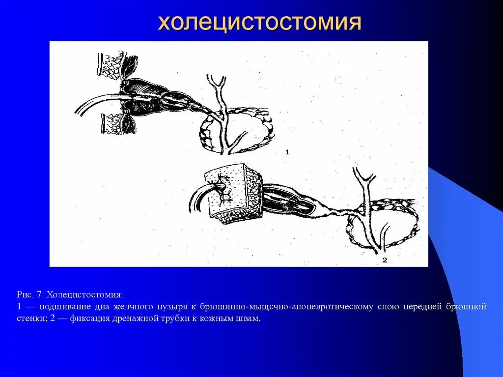 Холецистит дренаж. Холецистостомия дренаж. холецистостомия этапы операции. холецистостомия показания методики. эндоскопическая холецистостомия.