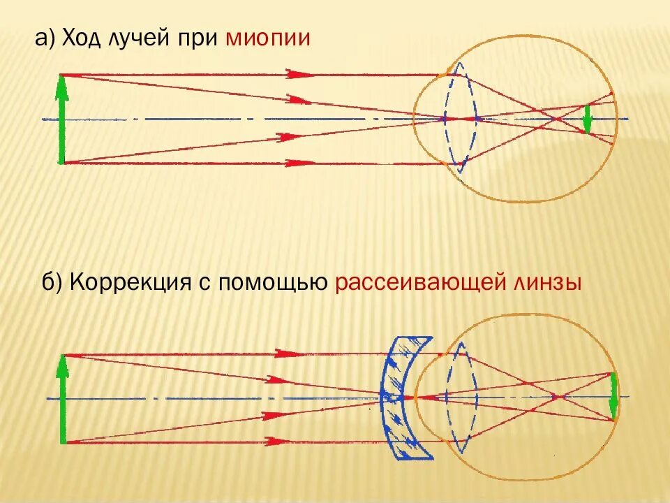 Ход лучей глаза человека. Близорукость схема хода лучей. Ход лучей в миопическом глазу. Дальнозоркость схема хода лучей. Ход лучей при близорукости схема.