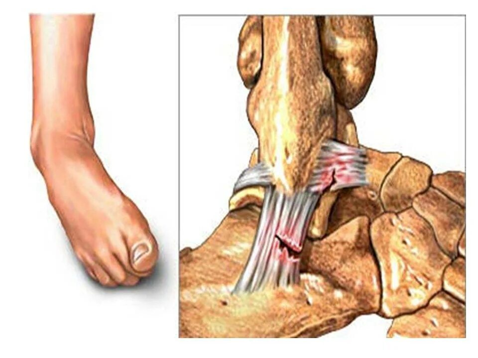 Растяжение связок и разрыв голеностопного сустава. Степени растяжения связок лодыжки. Дельтовидная связка голеностопного. Растяжения, повреждения связок..