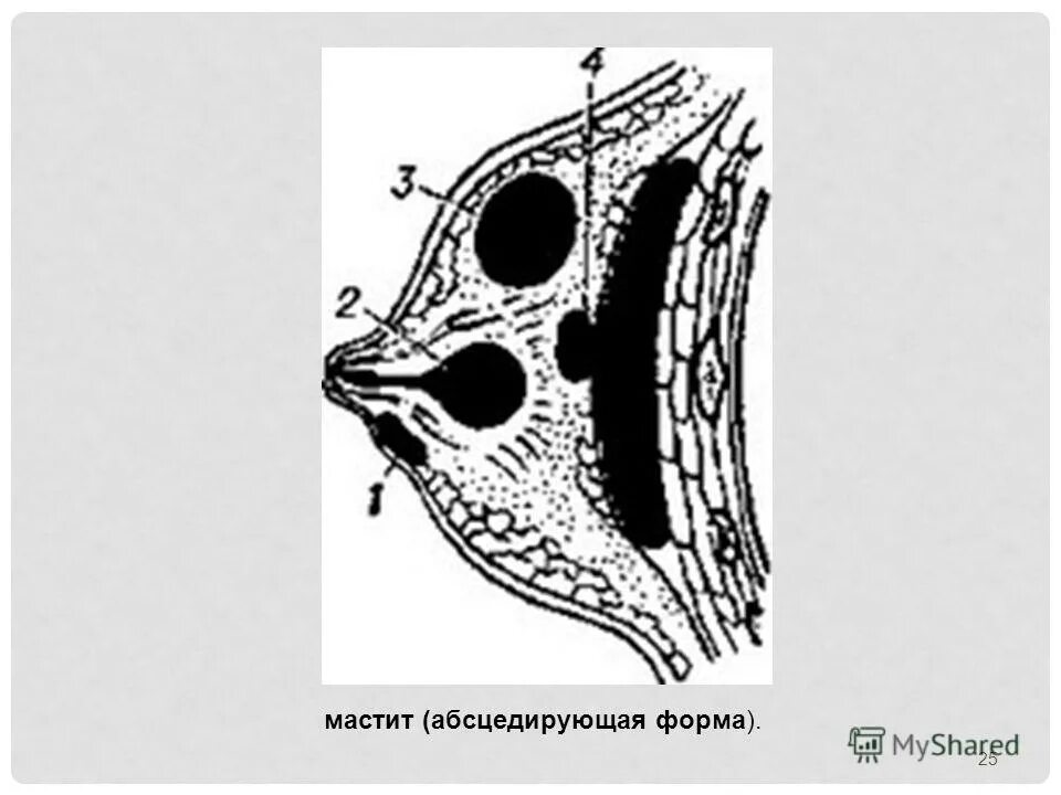 История болезни мастита. Мастит абсцедирующая форма.