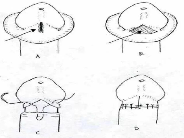 Что делать если головка не закрывается. Циркумцизио (обрезание крайней плоти) (схема 2). Пластика уздечки крайней плоти. Крайняя плоть венечная борозда. Операция обрезать уздечку.