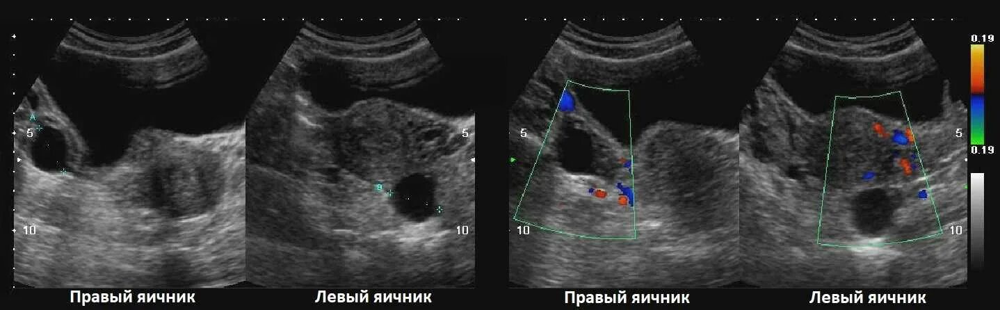 Киста левого яичника на УЗИ. УЗИ левого яичника с кистой 30 мм. Фолликулярная киста яичника.