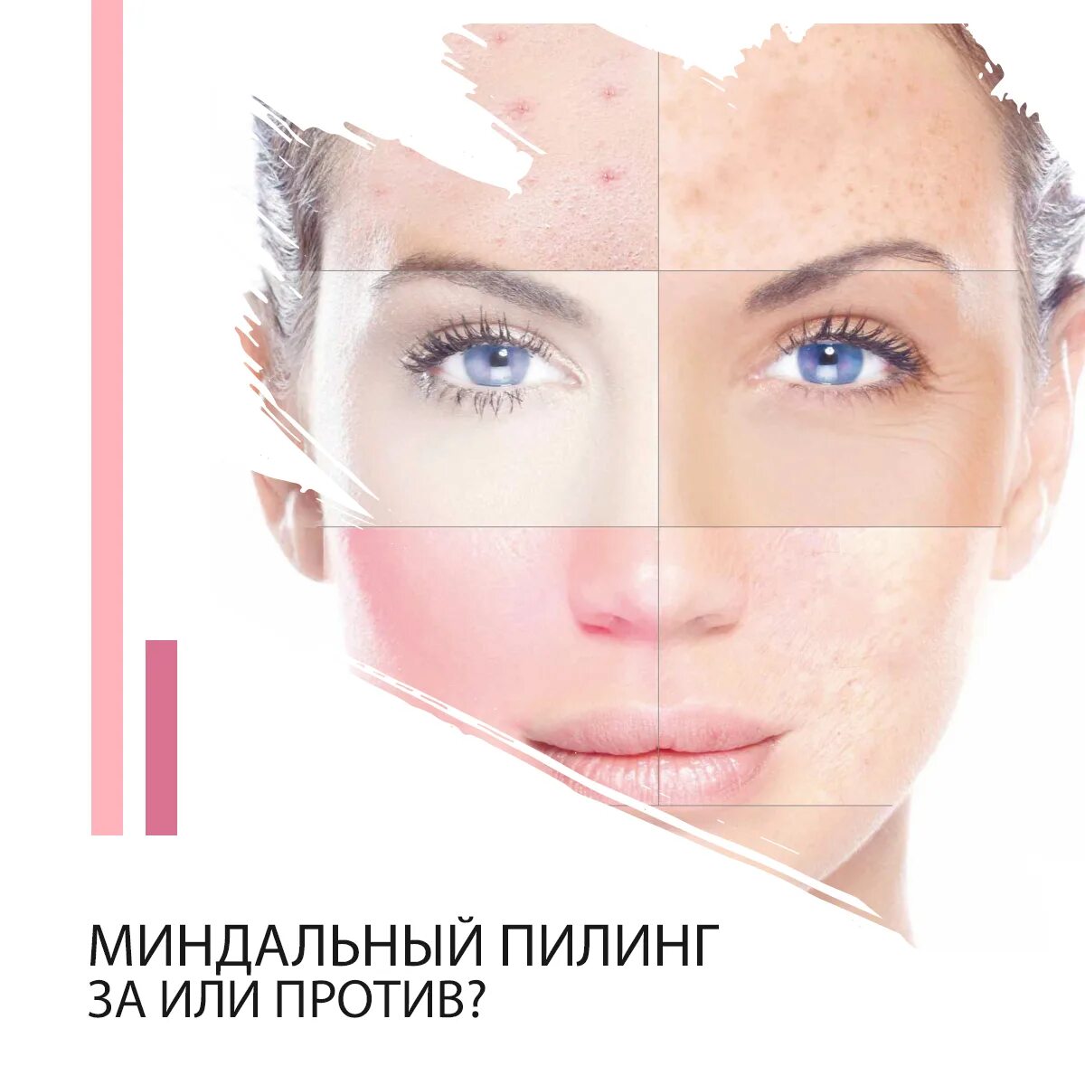 Миндальный пилинг цена skinlift ru. Миндальный пилинг. Пилинг миндальный для лица. Миндальный пилинг показания и эффект. Поверхностные пилинги.