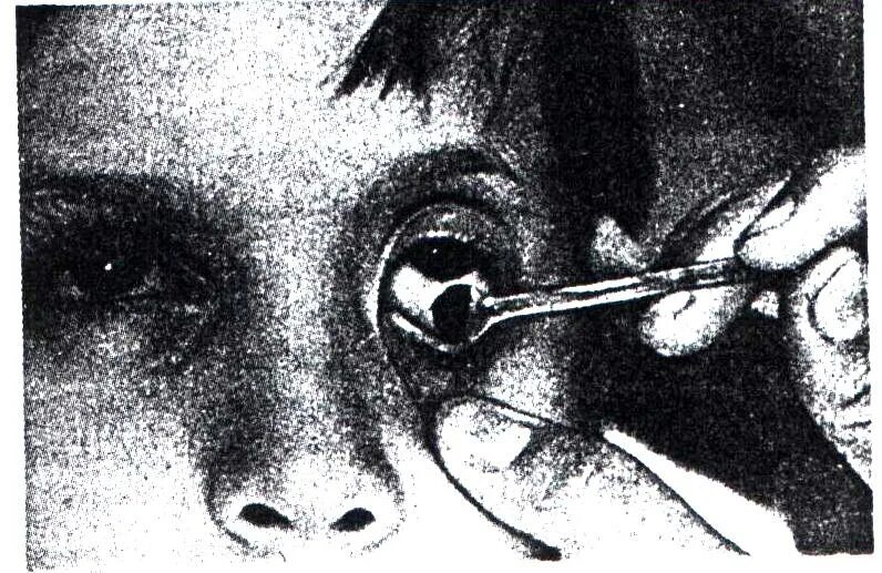 Соскоб с конъюнктивы на цитологию. Мазок с конъюнктивы. Мазок с конъюнктивы. Забор мазка с конъюнктивы. Coli в световой микроскоп.