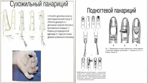 Рана кисти код
