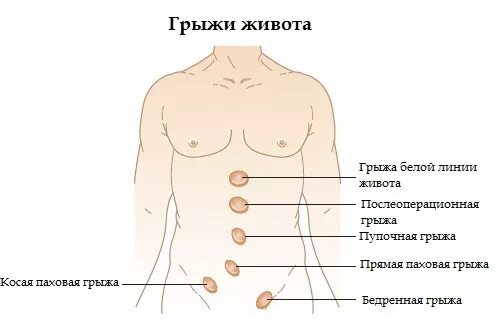 Симптомы грыжи живота у женщин слева. Грыжа живота классификация.