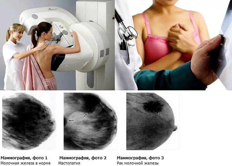 Маммография обязательно. Мастопатия молочной железы на маммографии. Молочная железа мастопатия маммография. Рентген молочных желез маммография. Маммография молочных желез РМЖ.