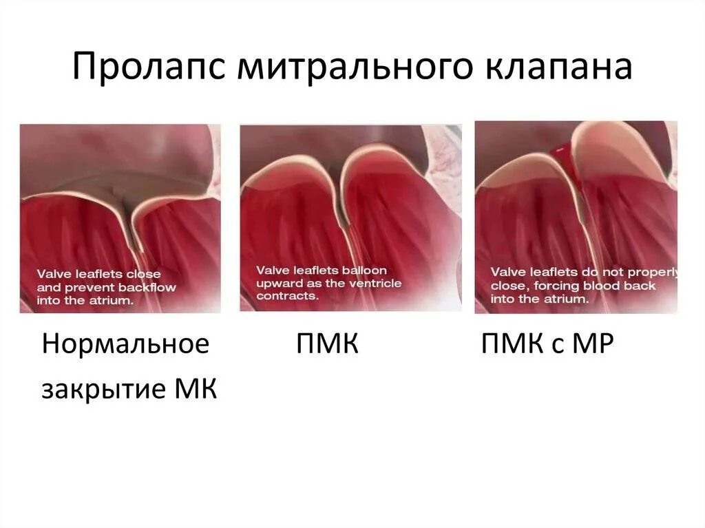 Что такое пролапс митрального клапана. Прогиб митрального клапана 1 степени. Пролапс митрального клапана симптомы. Симптомы пролапса митрального клапана 1. Пролапс митрального клапана 1 степени.