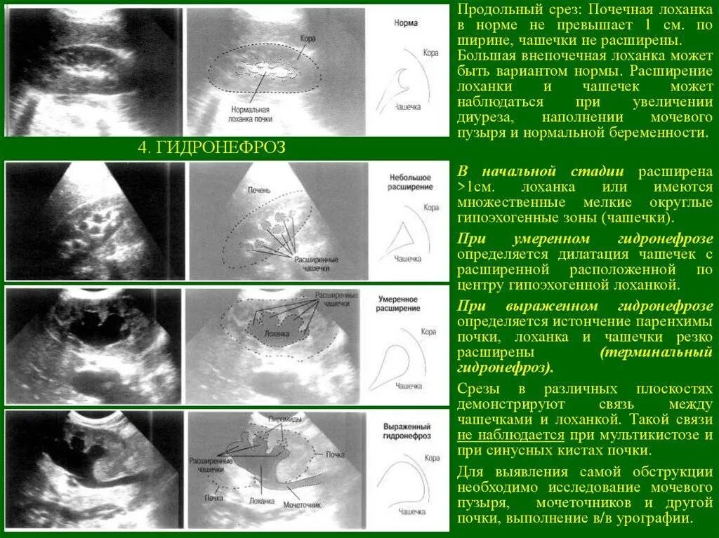 Будет расширена тем самым. УЗИ почек гидронефроз заключение. Гидронефроз УЗИ протокол. Расширение лоханки почки на УЗИ. Гидронефроз УЗИ признаки.