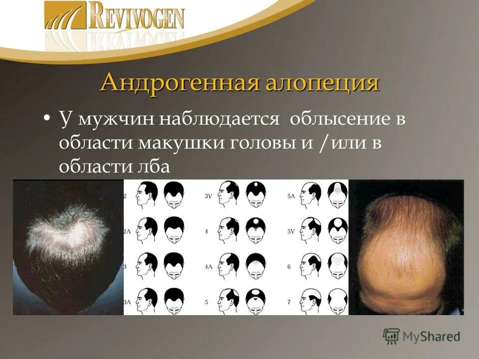 Диффузно андрогенная. Гнёздная алопеция диффузная. андрогенетическая диффузная алопеция. андрогенная алопеция алопеция. андроегнная алоцнпция.