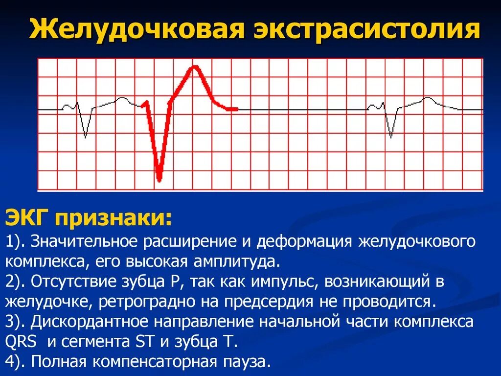 Экстрасистолия желудочков на ЭКГ. Экстрасистола желудочков на ЭКГ. Желудочковые экстрасистолы на ЭКГ. Одиночная желудочковая экстрасистолия на ЭКГ. 10 экстрасистола