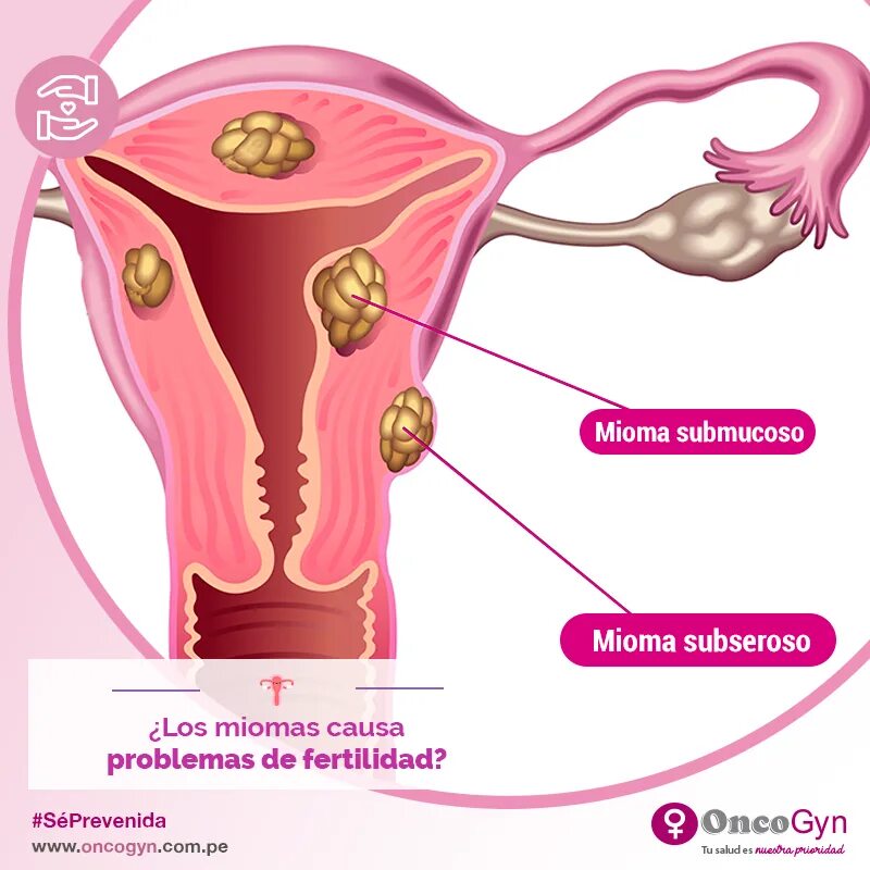 диетотерапии при миоме матки. питание при миоме матки. витамины при миоме и эндометриозе. миома матки похудение. сибирское здоровье миома матки.