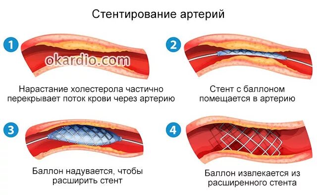 Стентирование артерий. Набор для стентирования коронарных артерий. Стентирование прогнозы