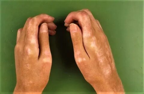 Склероз кожи