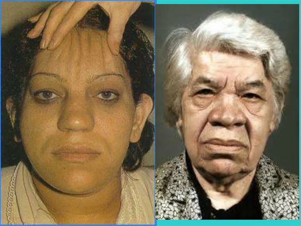 Причиныцвеличения селезёнки. Микседема и базедова болезнь. Токсический зоб базедова болезнь. Парциальный гигантизм нижней конечности. Заболевания гипофиза: гигантизм, акромегалия.