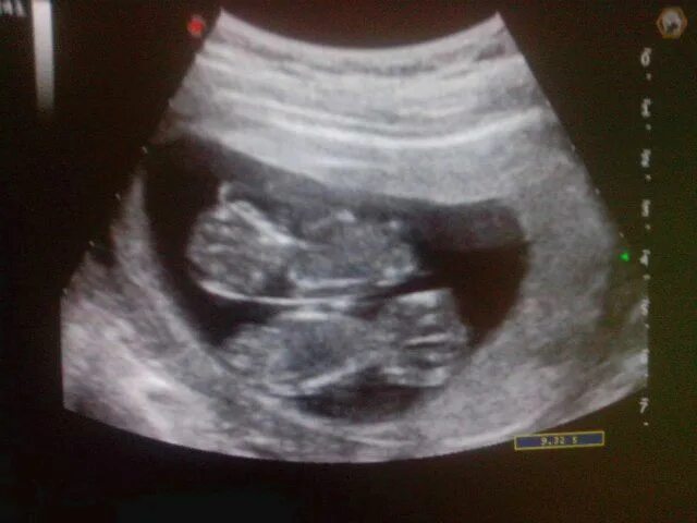 Узи двойни на 12. Узи 13 недель беременности двойня. Узи двойни на 12. Узи 7 недель беременности двойня. Узи 12 недель беременности двойня.