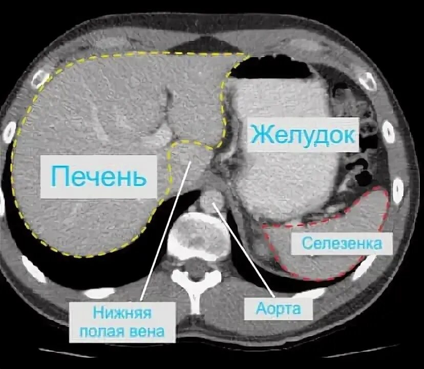 Кт томография брюшной полости. Компьютерная томография живота. Язва кт