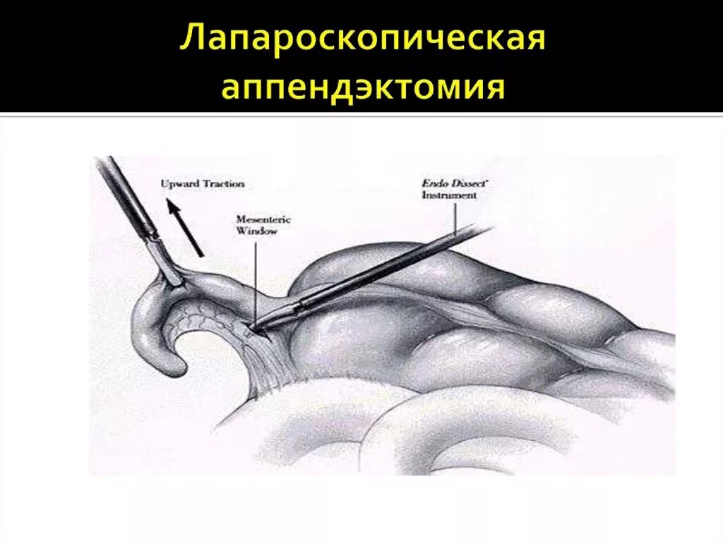 При аппендиците повышается