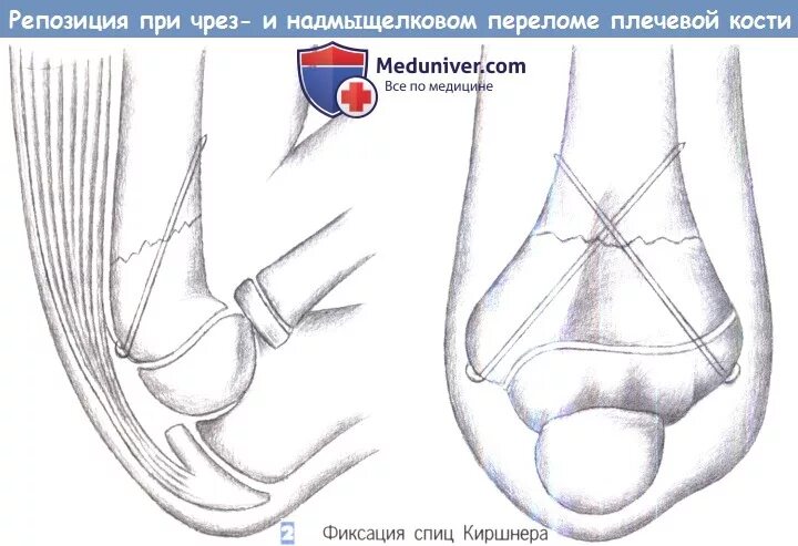 Закрытая репозиция это. Закрытая репозиция это