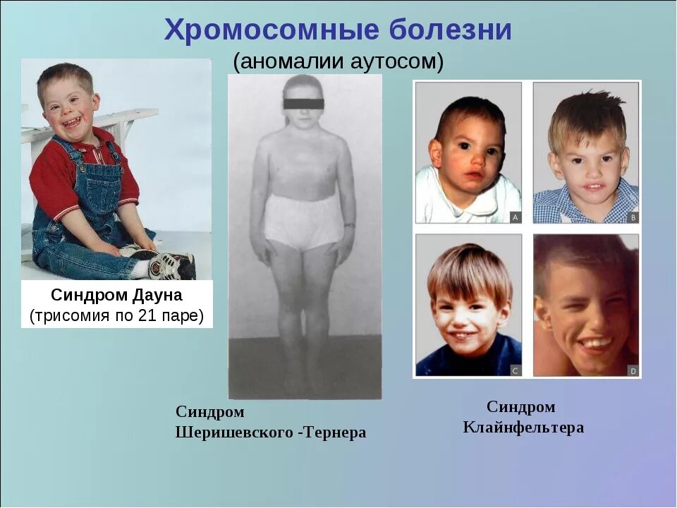Хромосомные болезни аномалии аутосом. Синдром Дауна трисомия 21. Хромосомные болезни человека аномалия аутосом. Дети с хромосомными нарушениями.