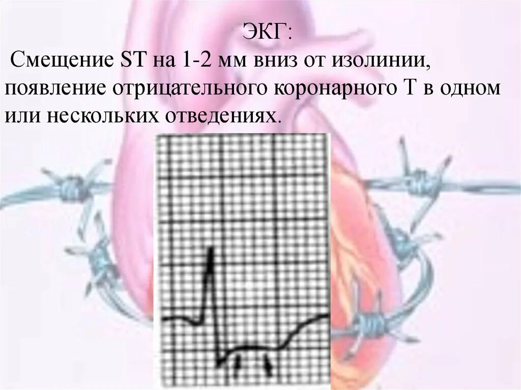 Смещение st вверх v4 v5. Экг смещение st вниз. смещение ст вниз на экг. смещение изолинии на экг вниз. ст на изолинии экг.