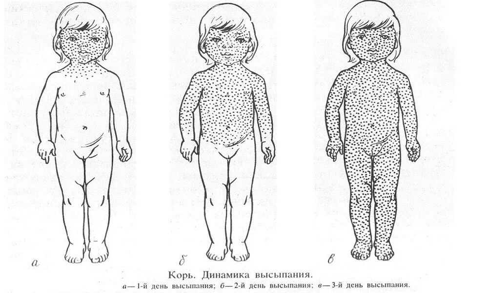 Неспецифическая профилактика краснухи. Течение кори у детей. Специфическая профилактика при кори. Особенности течения кори у привитых. Заболевание корь проявление.
